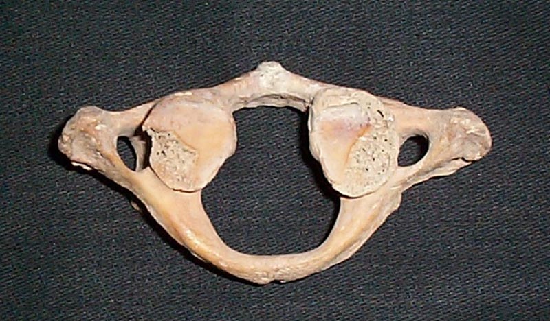 Scheletul 2. Prima vertebră cervicală (atlasul) faţa inferioară. Arcul anterior se află în partea de sus a imaginii. Se observă secţionarea faţetelor articulare inferioare